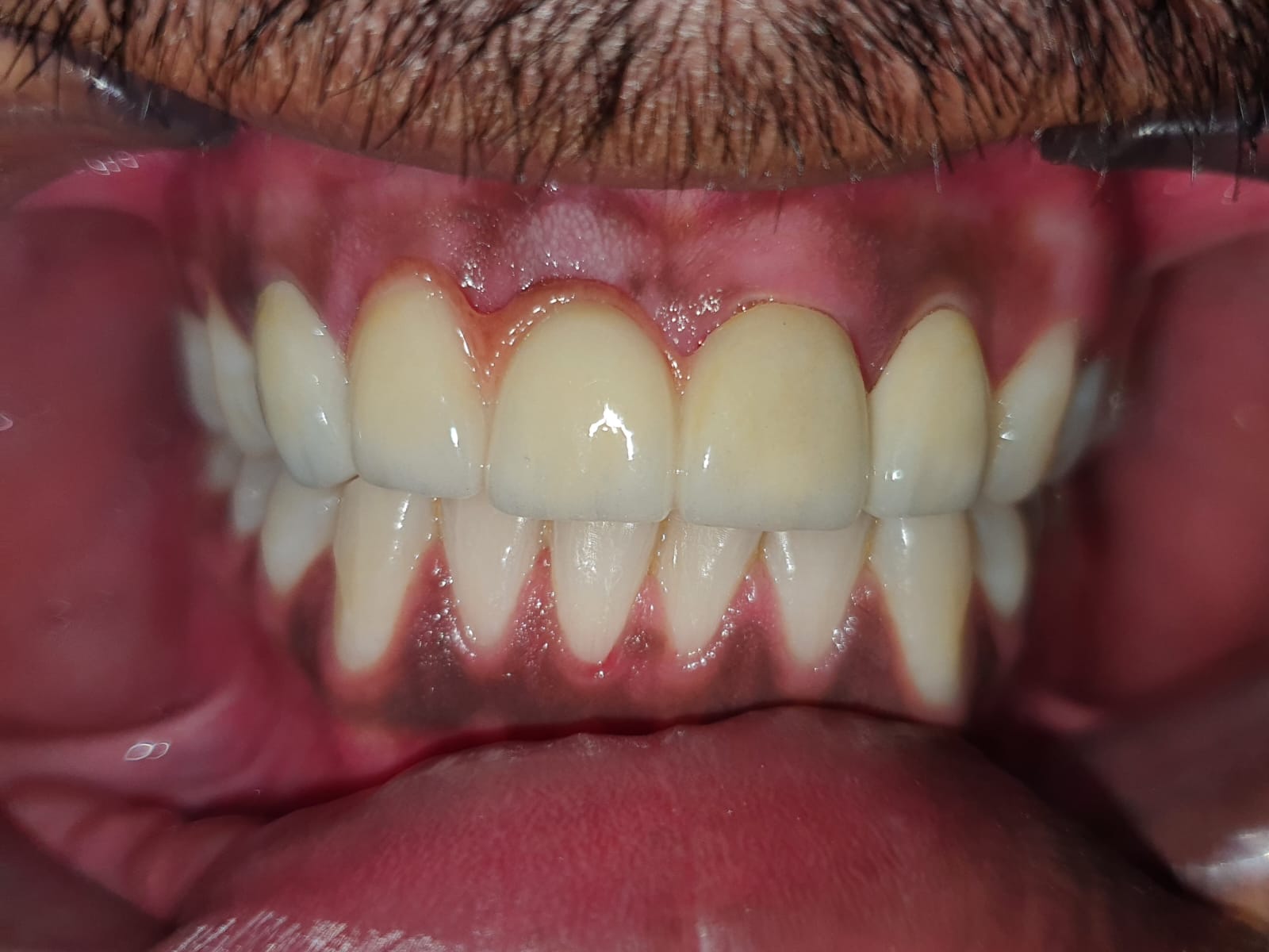 After dental treatment