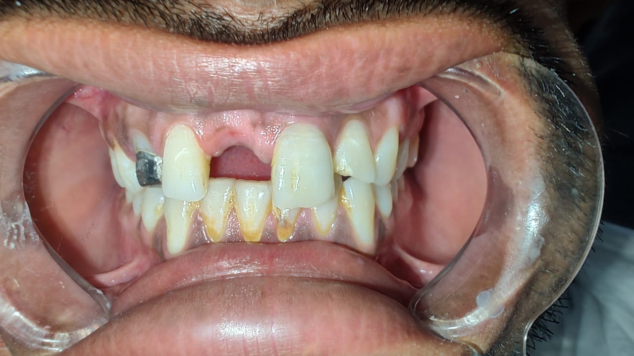 Before dental treatment