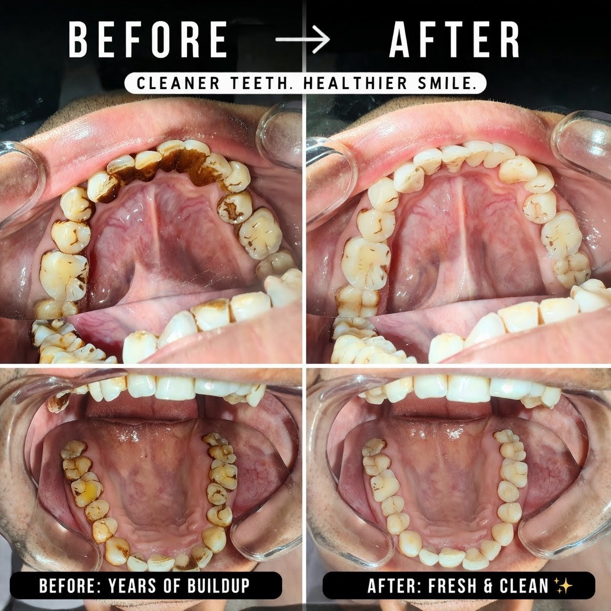 Before and after smile makeover